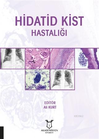 Hidatid Kist Hastalığı Ali Kurt